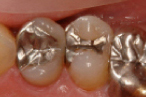 従来のインレーによる治療