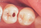 MIに基づいたコンポジットレジンによる治療